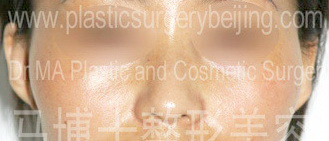 protruding zygomatic bone and zygomatic arch