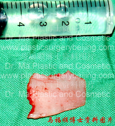 Nasal septal cartilage for nasal elongation