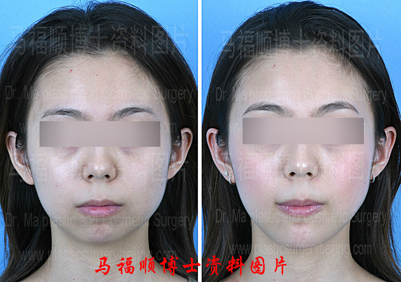 advancement genioplasty pre and post operation pictures