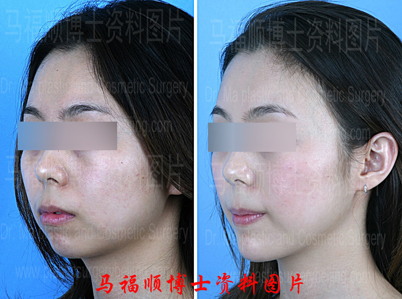 oblique view pictures of Forward Sliding Genioplasty
