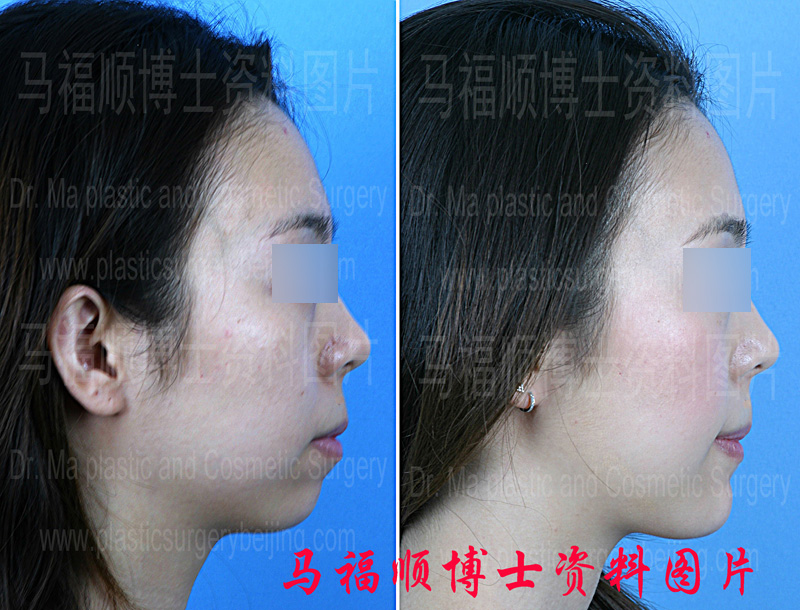 Profile pictures of advancement genioplasty