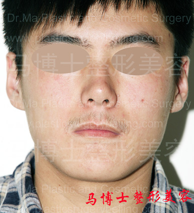 Revision Surgery of Mandible and Masseter Muscle Redution, pre-operation