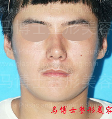 Revision Surgery of Mandible and Masseter Muscle Redution, post-operation