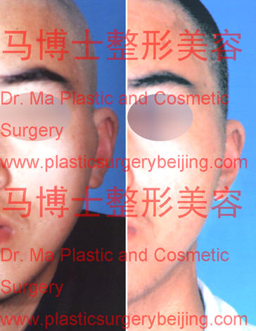 comparison pictures of zygoma reduction plastic surgery