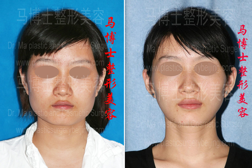 mandible reduction surgery pre- and post operation