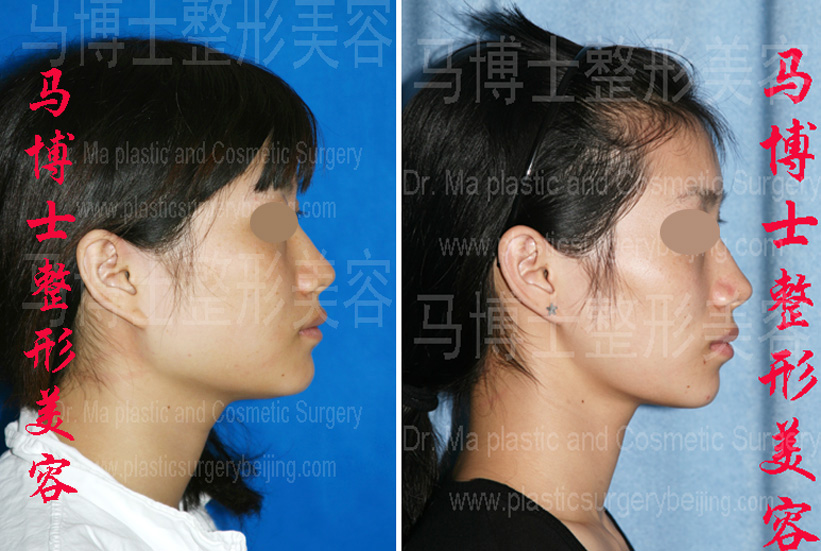 mandible reduction surgery pre- and post operation,profile