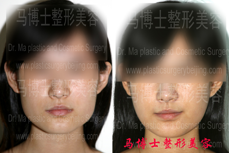 mandible reduction and masseter muscle resectomy surgery, pre- and post operation