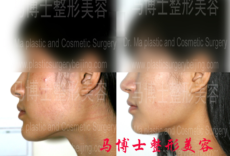 mandible reduction and masseter muscle resectomy surgery, pre- and post operation, profile