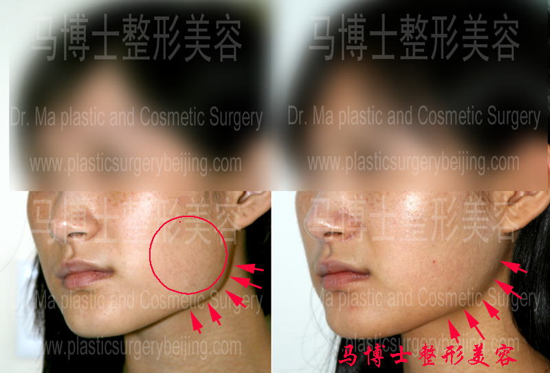 mandible reduction and masseter muscle resectomy surgery, pre- and post operation,45 degree angle view