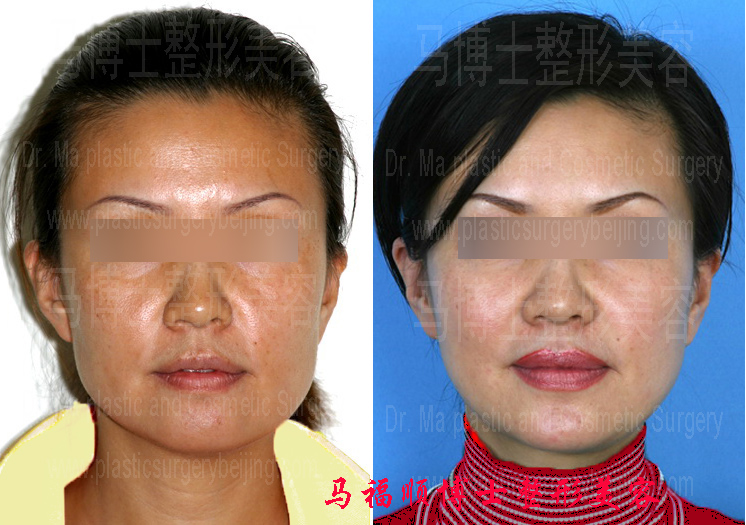 Reduction Plastic Surgery of Asymmetric Mandible Bone pre and post operation pictures