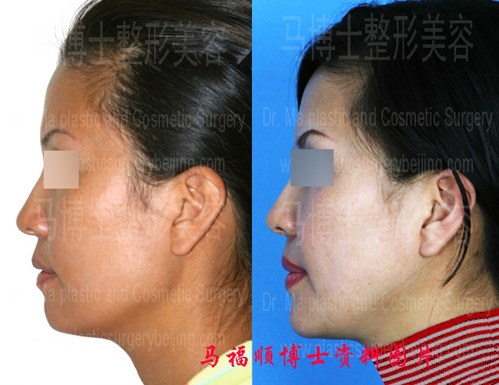 profile pictures of asymmetric mandible reduction plastic surgery