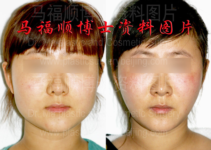 Mandible Sculpture and Masseter Muscle Reduction Surgery pictures
