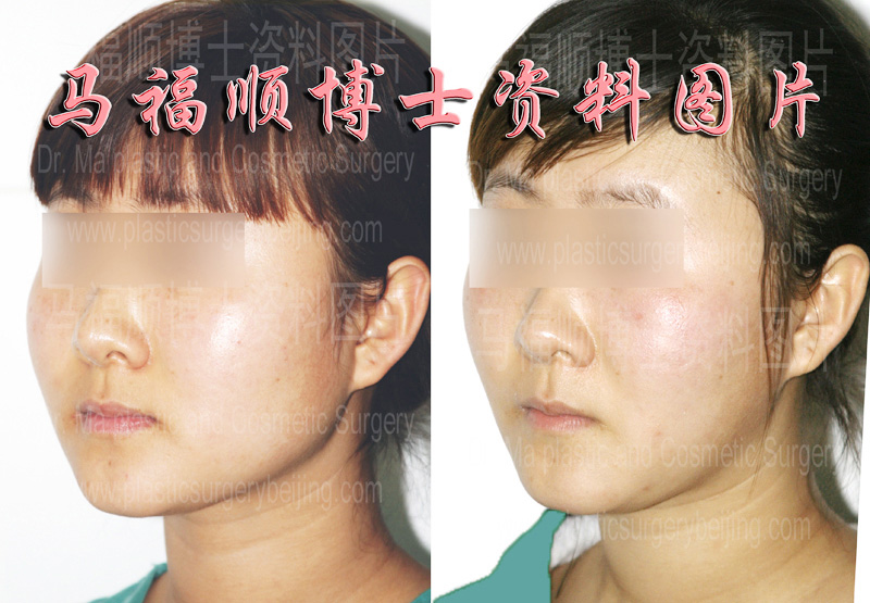 Oblique view of Mandible Sculpture and Masseter muscle Reduction Surgery pictures