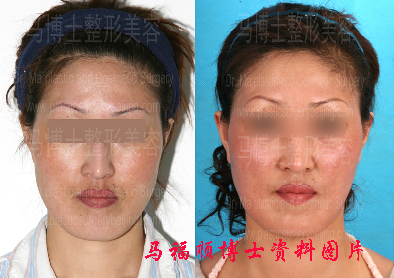 Pre and post operative pictures of crossbite correction plastic surgery Pre and post operative pictures of crossbite correction plastic surgery