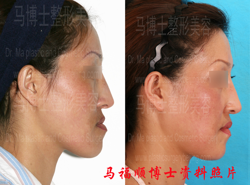comparison pictures of crossbite correction plastic surgery comparison pictures of crossbite correction plastic surgery