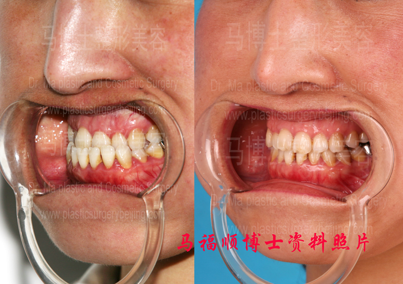 Comparison pictures of overbite correction plastic surgery Comparison pictures of overbite correction plastic surgery