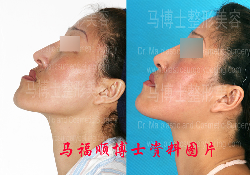 Comparison pictures of crossbite correction plastic surgery at chin up position Comparison pictures of crossbite correction plastic surgery at chin up position