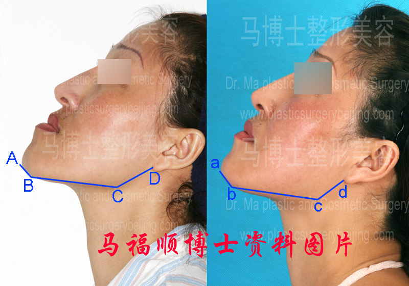 Picture analysis of crossbite correction plastic surgery at chin up position Picture analysis of crossbite correction plastic surgery at chin up position