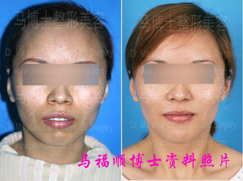 Bimaxillary protrsion pre and post operation pictures front view.