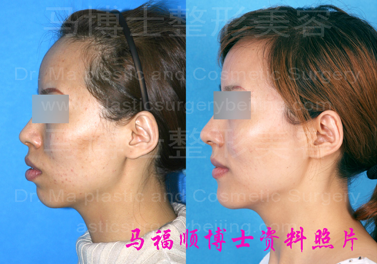 Bimaxillary protrsion pre and post operation pictures in a lateral view.