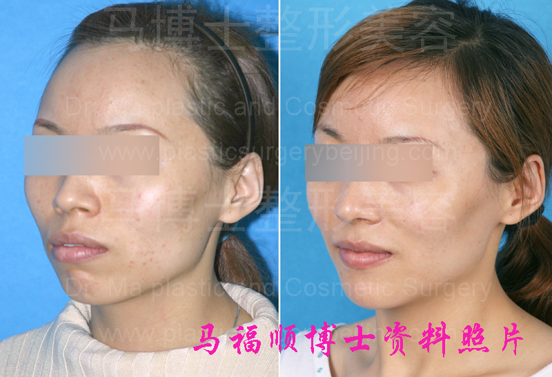 Bimaxillary protrsion pre and post operation pictures in a 45 degree view. 