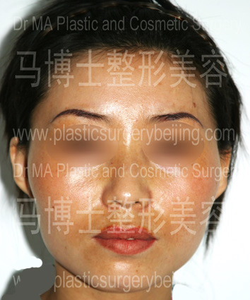 Front view of the protruding zygoma and zygomatic arch