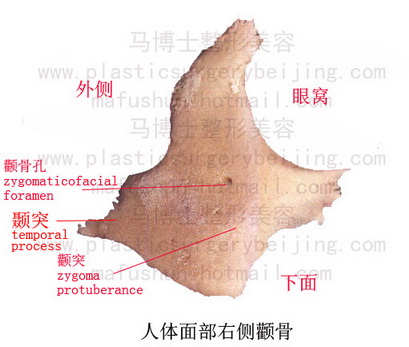 zygoma reduction plasty, post operation indentation in the zygoma area