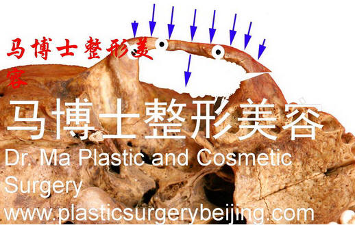 zygoma smooth reduction surgery