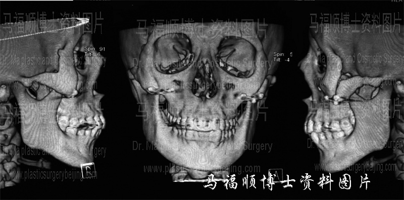 complication of zygomatic bone and zygomatic arch