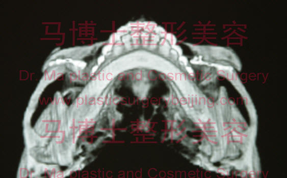 zygoma redcution plasty CT, inferior and medial rotation