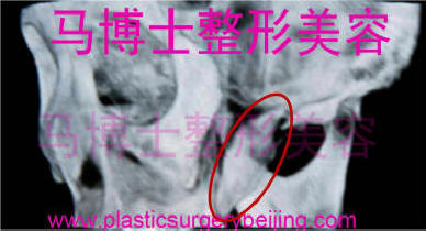 zygoma ptosis