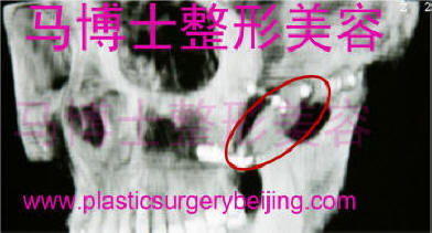 zygoma ptosis restored