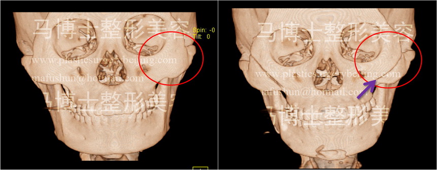zygoma plasty pre- and post-op, no change noticed