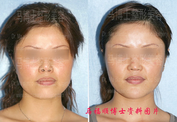 Nasal elongation and bimaxillary correction plastic surgery pre and post operation pictures