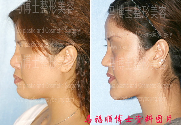 Nasal elongation and bimaxillary correction plastic surgery pre and post operation pictures in profile