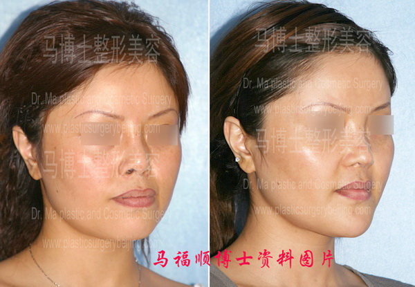 Nasal elongation and bimaxillary correction plastic surgery pre and post operation pictures in 45 degree angle