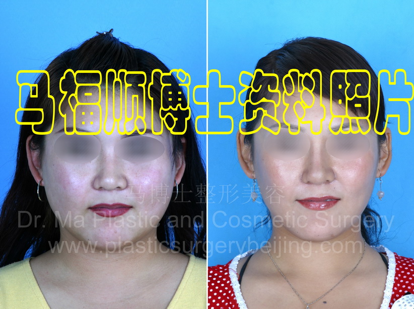 pictures befor and after facial contour surgery