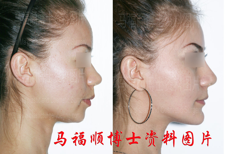Changes after mandible angle reduction and chin forwarding surgery in profile