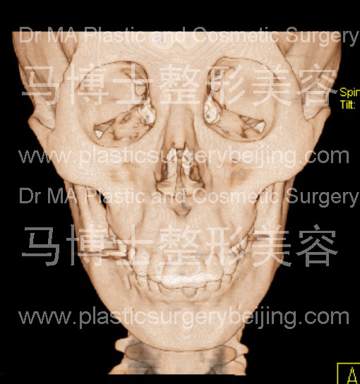 narrow facial bone