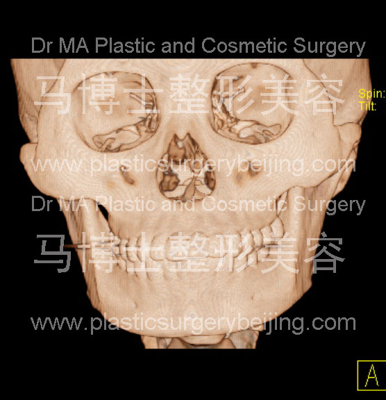 wide facial bone