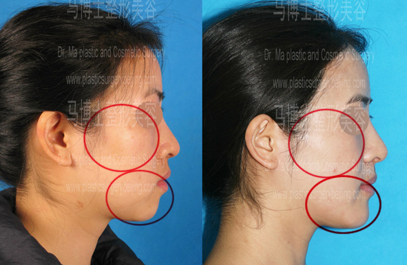 Zygoma and Zygomatic Arch Reduction Plus Chin Forwarding Surgery, lateral view
