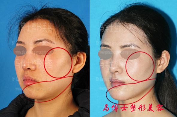 Zygoma and Zygomatic Arch Reduction Plus Chin Forwarding Surgery