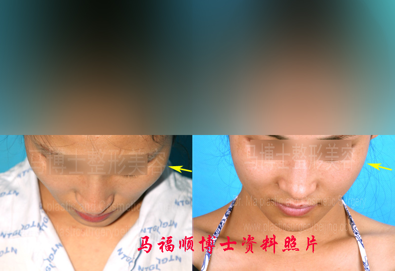 pictures of zygoma plastic surgery and zygomatic arch reduction surgery after two months post operation at chin donwn position.