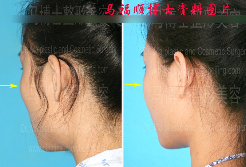 Comparison pictures of zygoma plastic surgery and zygomatic arch
reduction surgery after two months post operation at rear view position.
