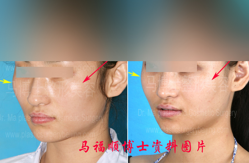Two months after zygoma plastic surgery and zygomatic arch reduction surgery
