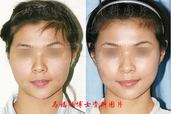 Zygoma and zygomatic arch smooth reduction picutres before and after operation