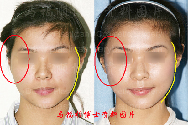 Comparing guide of smooth zygoma reduction pictures