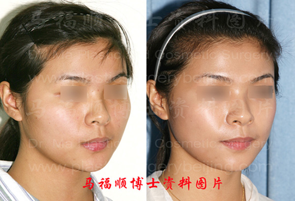 comparing pictures of zygoma and zygomatic arch reduction plastic surgery in 45 degree angle