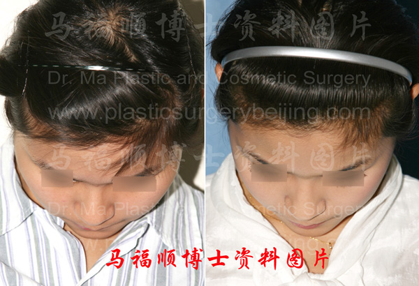 zygoma and zygomatic arch reduction surgery pre and post operation