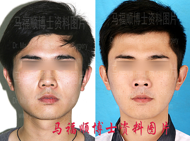 photos of zygoma and mandible reduction with partial masseter muscle resectomy surgery photos of zygoma and mandible reduction with partial masseter muscle resectomy surgery
